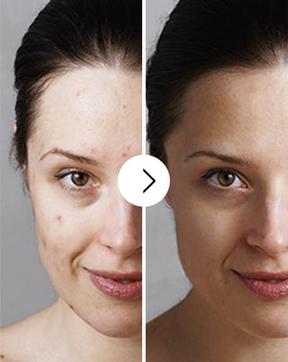 Akne, finnar och ojämnheter tabletter med zink, vitamin C, E och B2 Derminax_3 - 3