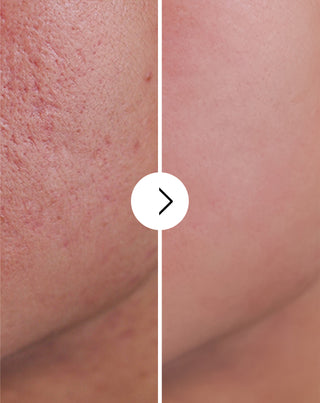 Akne, finnar och ojämnheter tabletter med zink, vitamin C, E och B2 Derminax_4 - 4