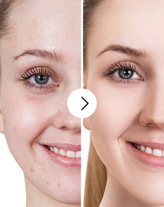 Akne, finnar och ojämnheter tabletter med zink, vitamin C, E och B2 Derminax_6 - 5