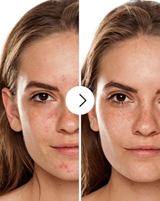 Akne, finnar och ojämnheter tabletter med zink, vitamin C, E och B2 Derminax_2 - 2